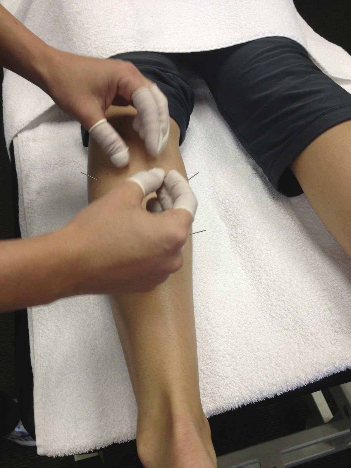 Needling Therapy Img